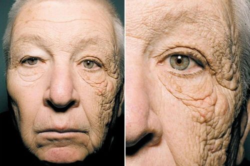 Tek-Yonlu-Dermatoheliyoz