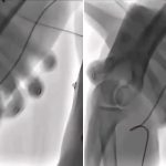 Sağ Bacak İçindeki Popliteal Arterin Masajla Düzeltildiği Ana Ait Sanılan Görüntü anjiyo-kateter-duzeltme