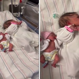 ikizden-ikize-transfuzyon-sendromu