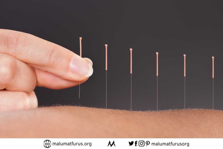 akupunktur