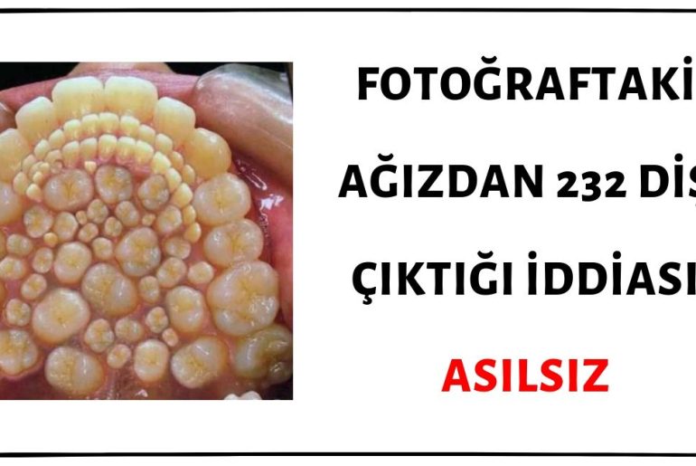 Görseldeki Hyperdontiadan Muzdarip Ağızdan 232 Dişin Çıktığı İddiası