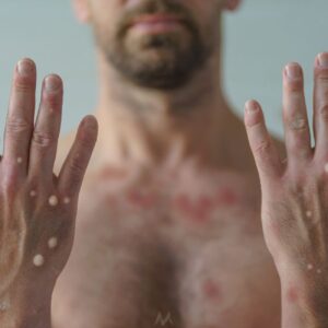 maymun-cicegi-virusu