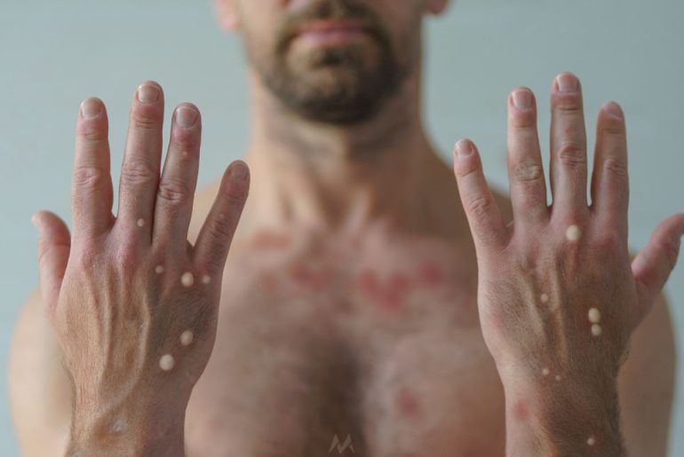 maymun-cicegi-virusu