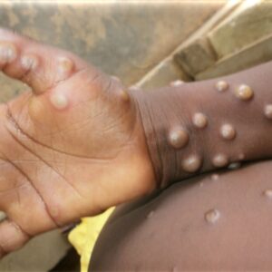 maymun cicegi virusu