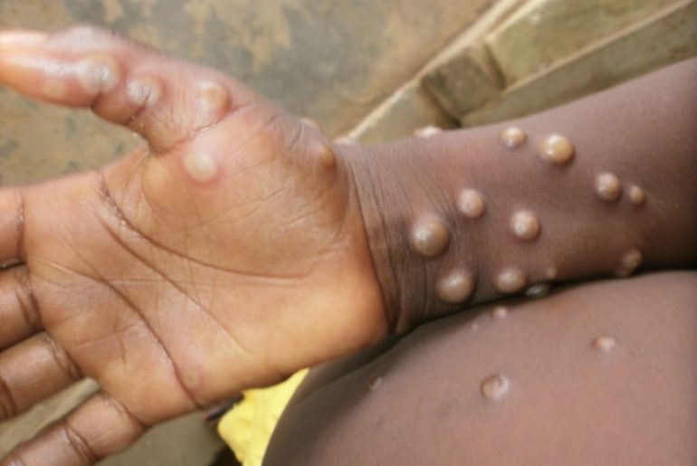 maymun cicegi virusu