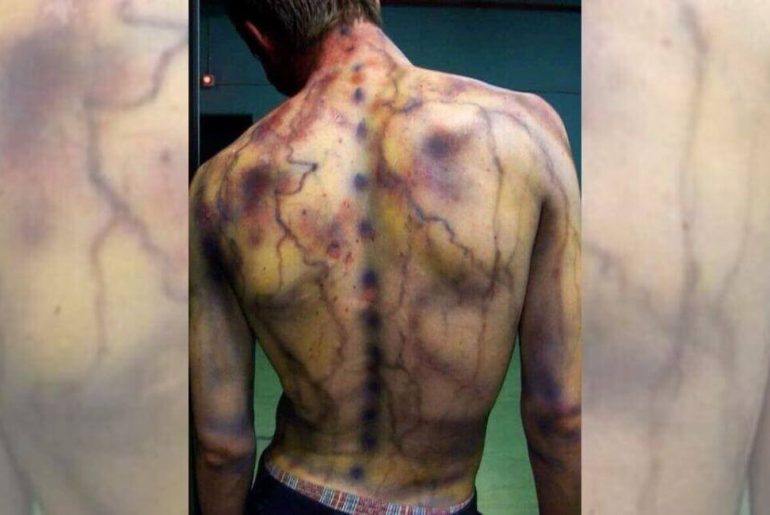 yildirim-carpmis-insan